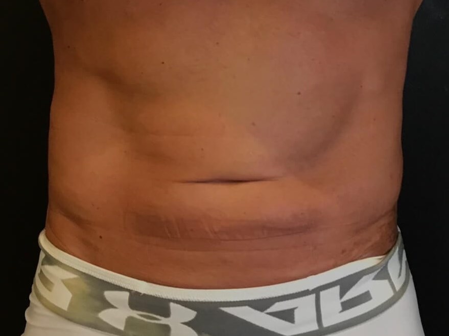 Cool Sculpting Flanks After