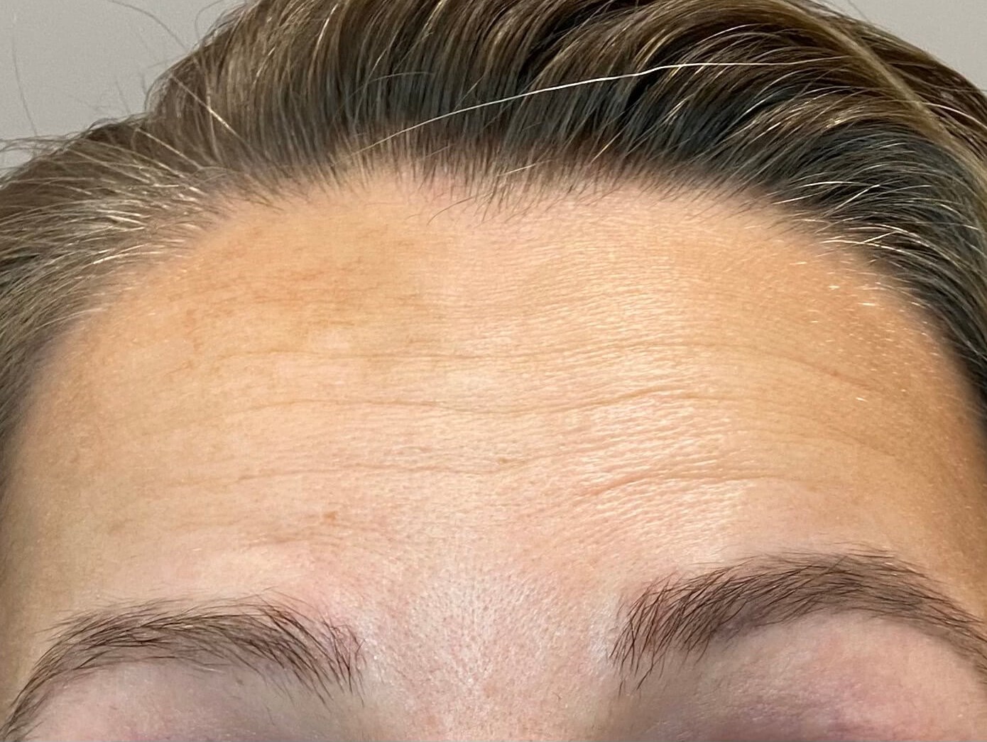 botox forehead lines Before