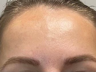 botox forehead lines After