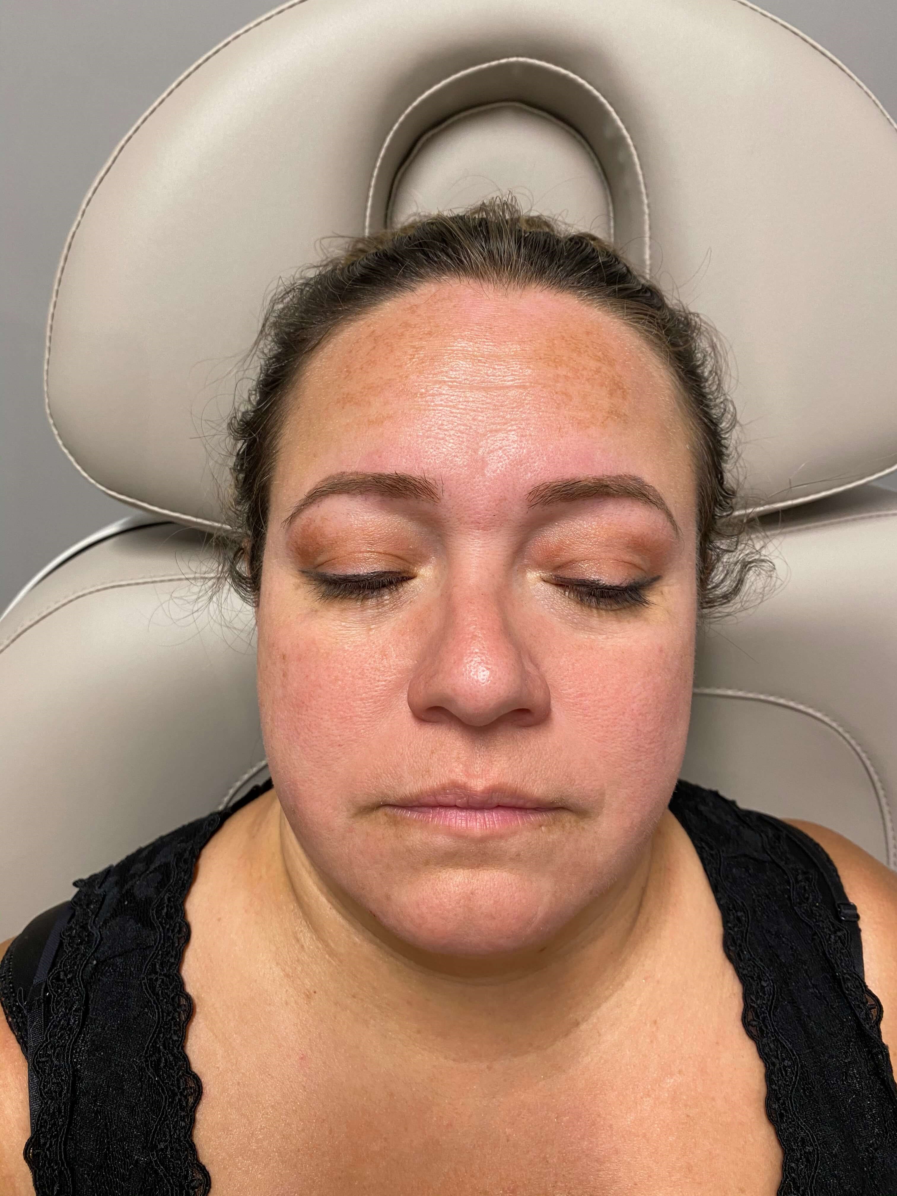 Juvederm Lip Fillers Before