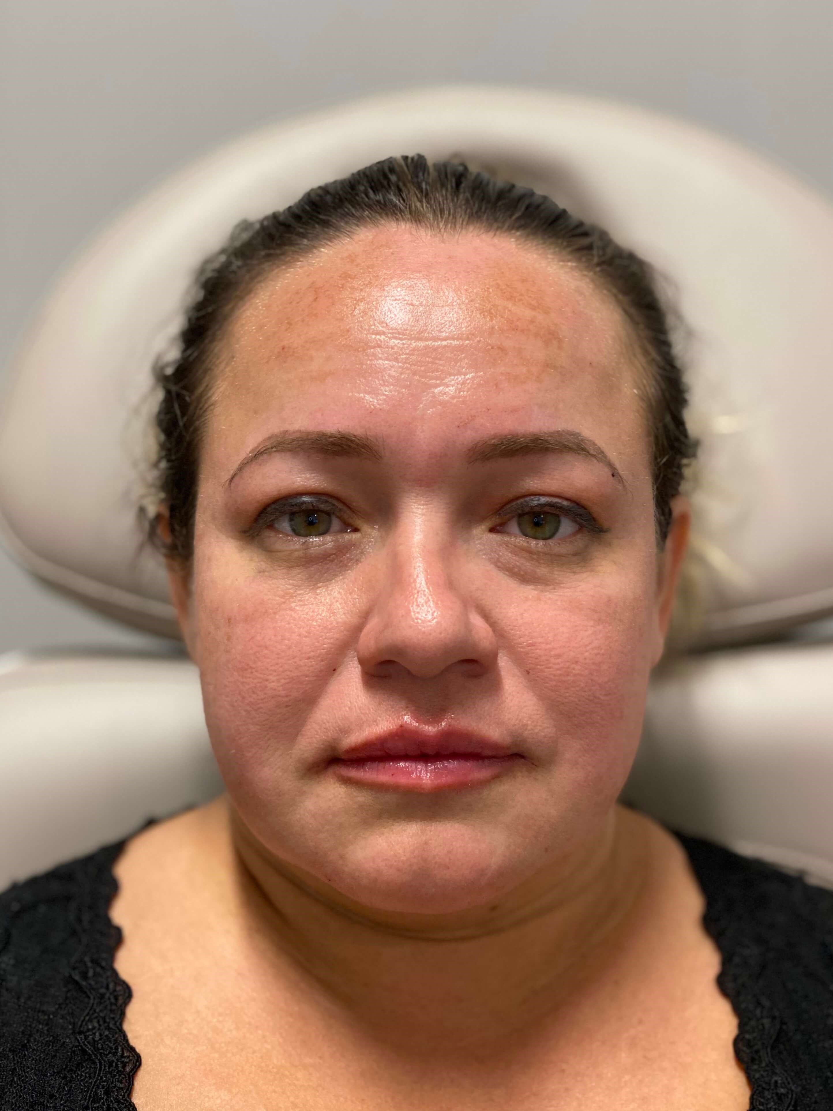 Juvederm Lip Fillers After