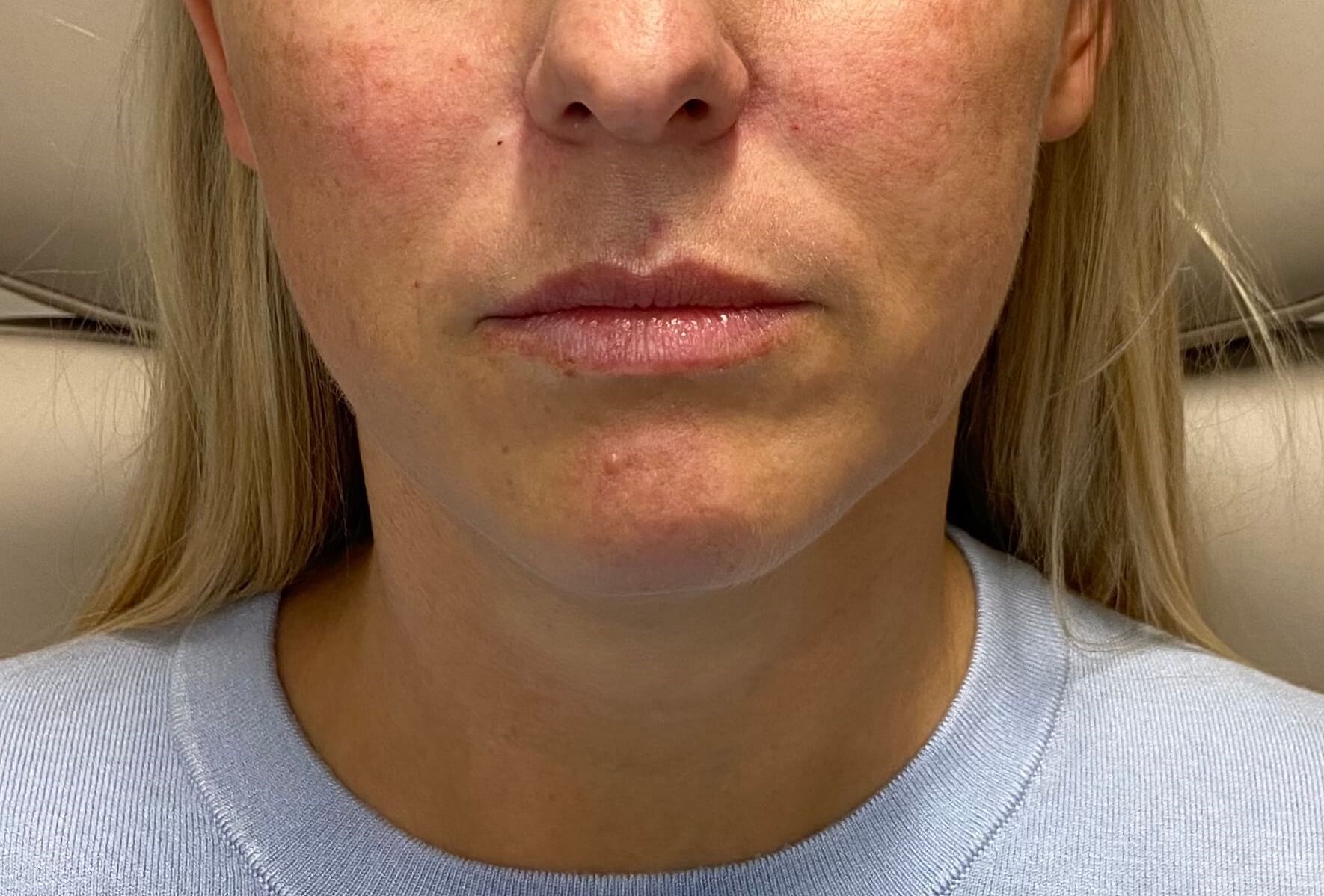Juvederm Lip Enhancement Before