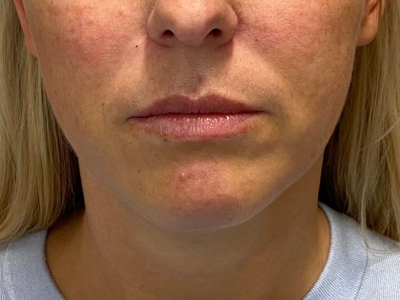 Juvederm Lip Enhancement Before