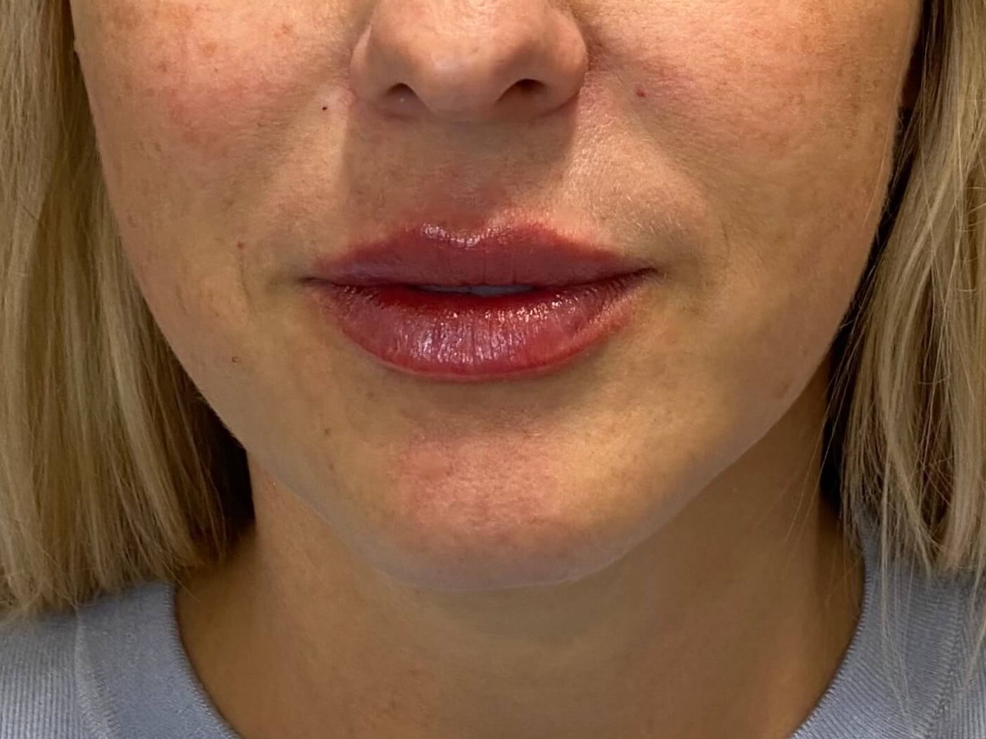 Juvederm Lip Enhancement After