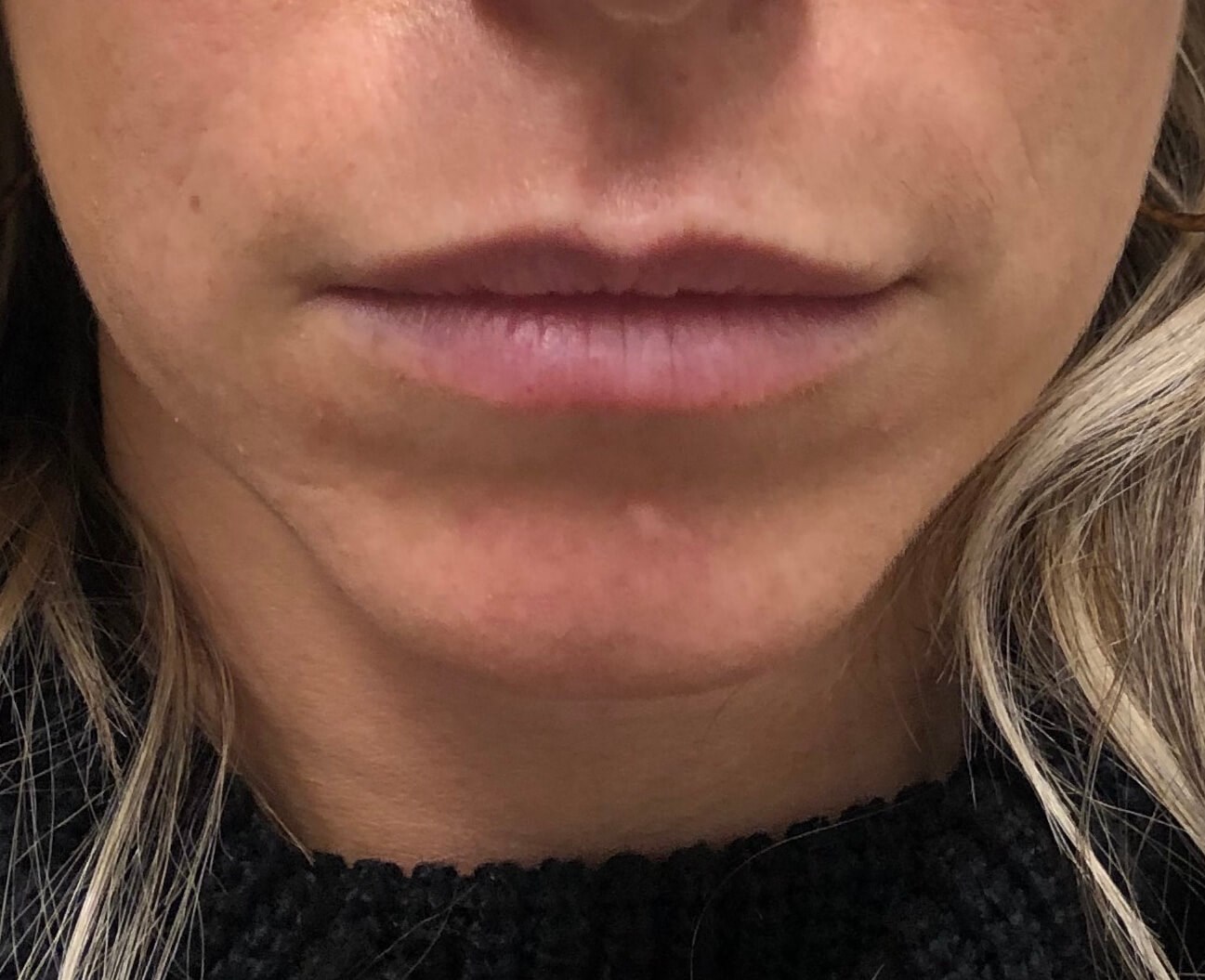 Juvederm Lip Enhancement Before