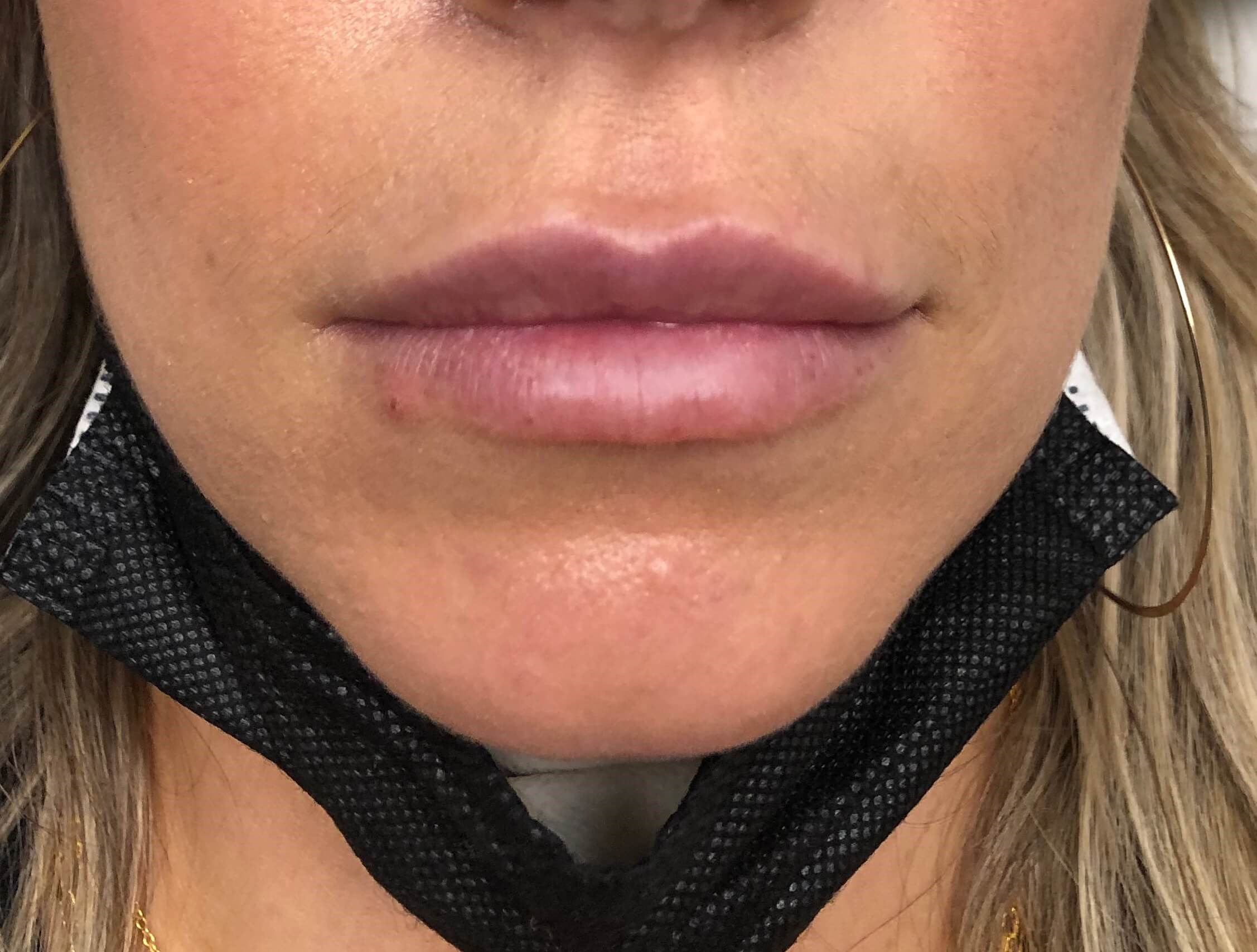 Juvederm Lip Enhancement After