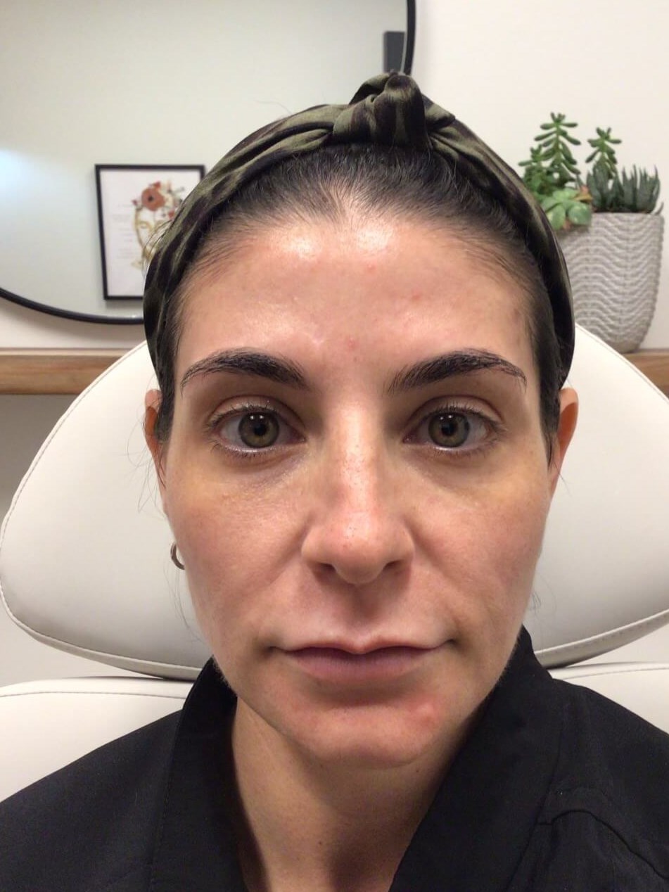 Juvederm Face volume loss Before