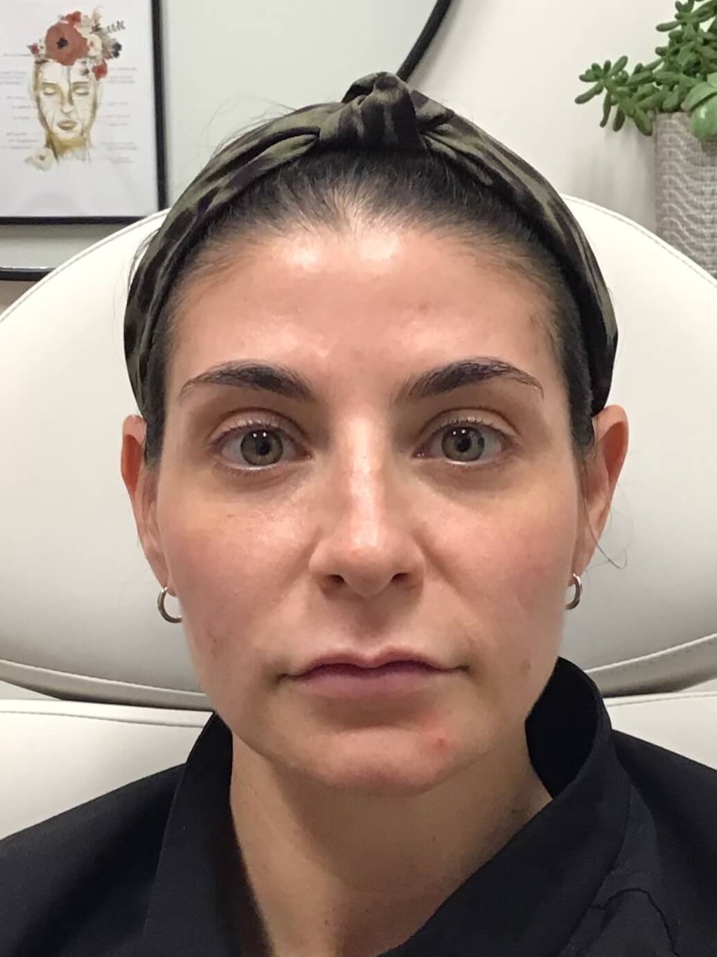 Juvederm Face volume loss After