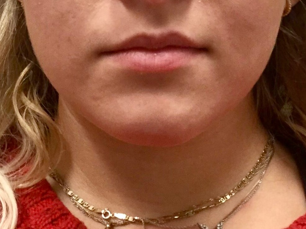 Juvederm Ultra Lips Before
