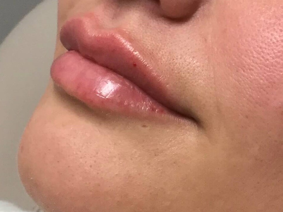 Restylane Kysse Lips After
