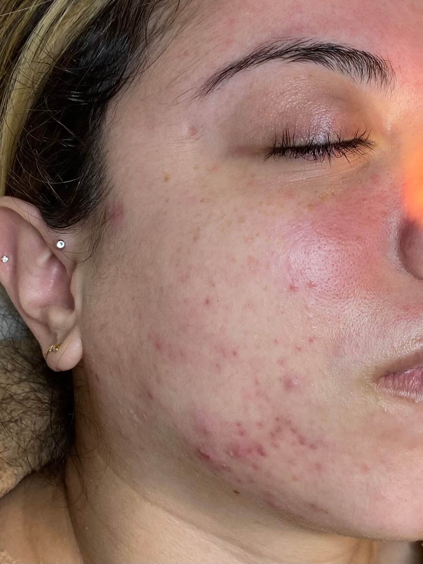 Chemical Peel Series Before