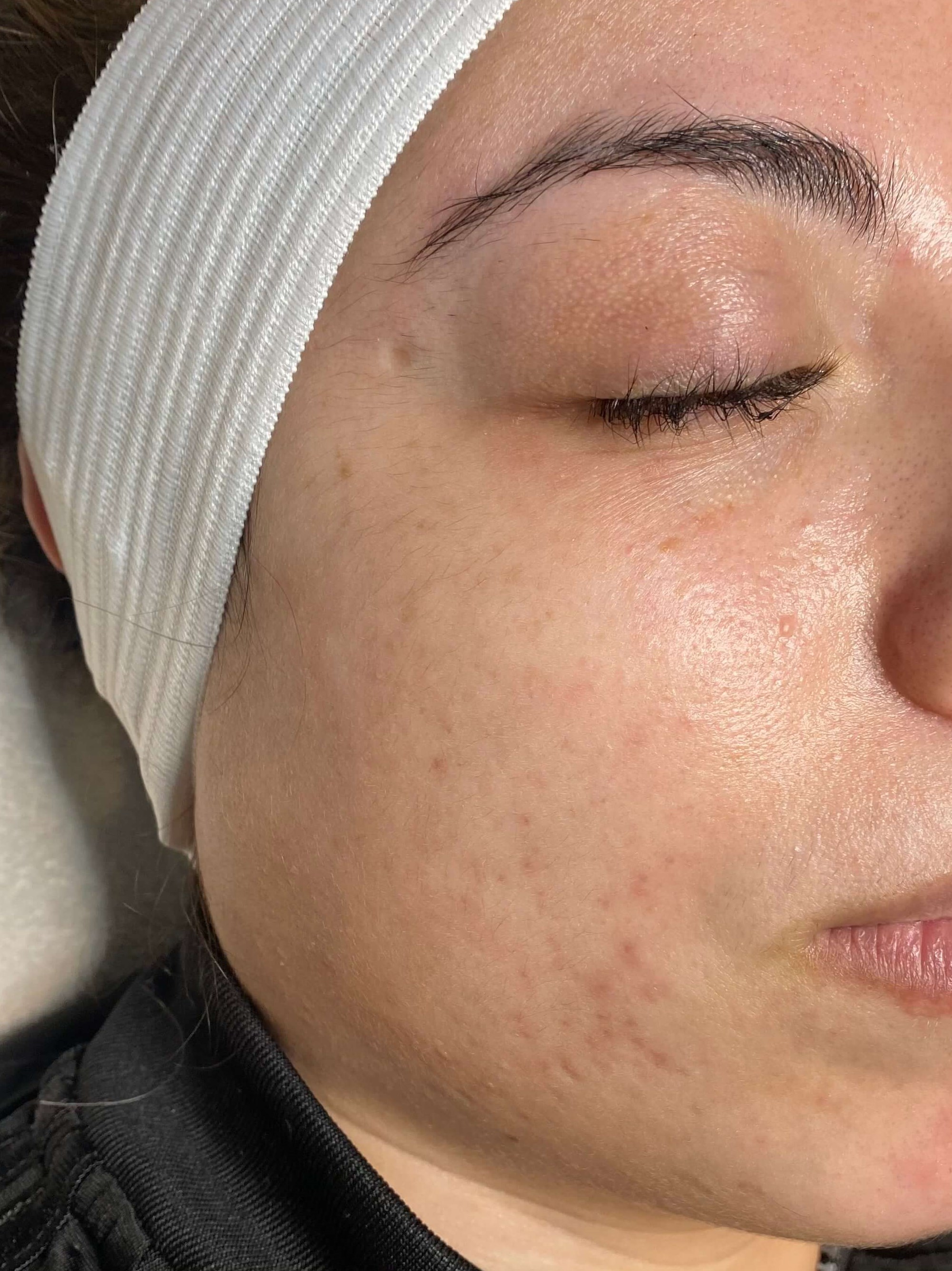 Chemical Peel Series After