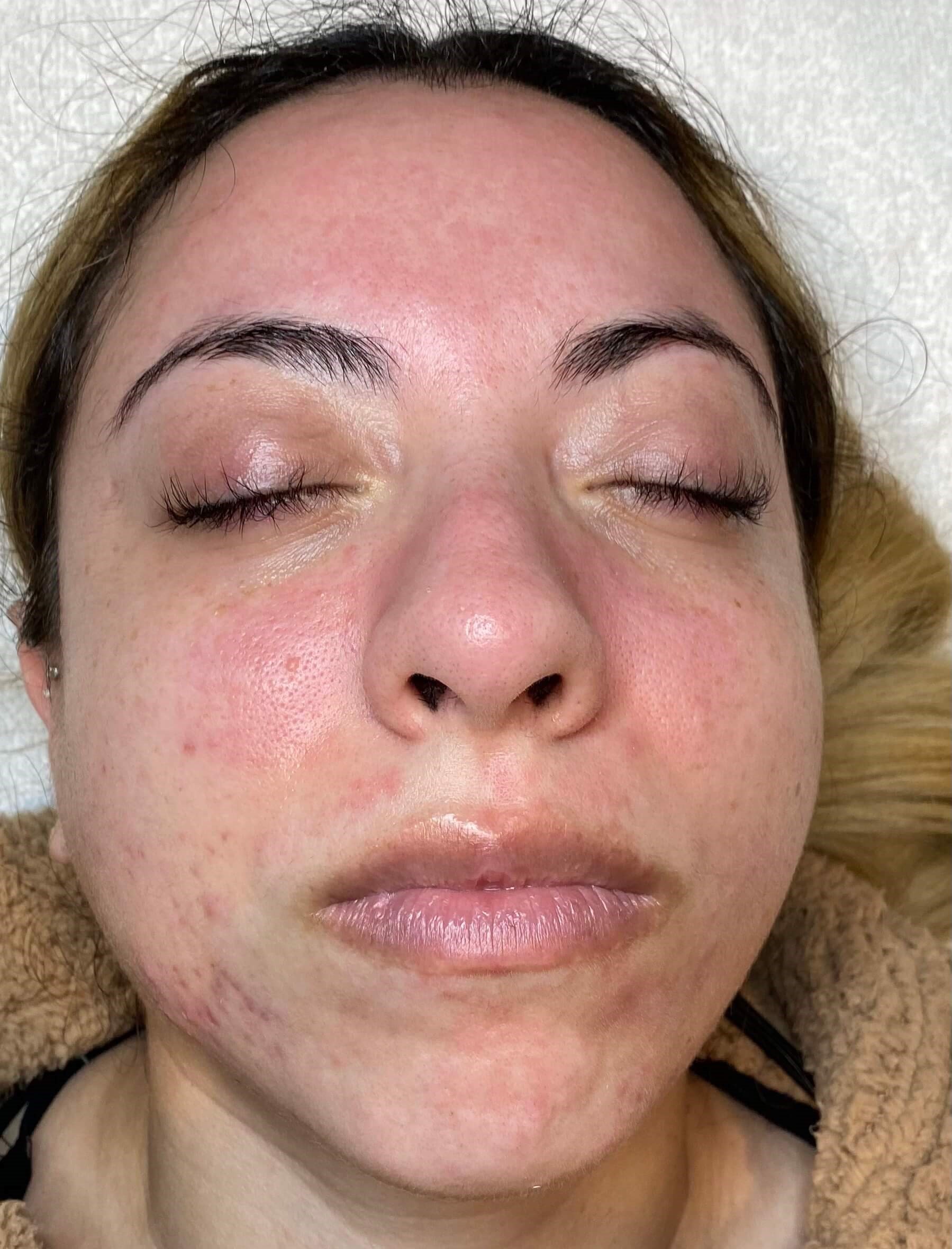 Chemical Peel Series Before