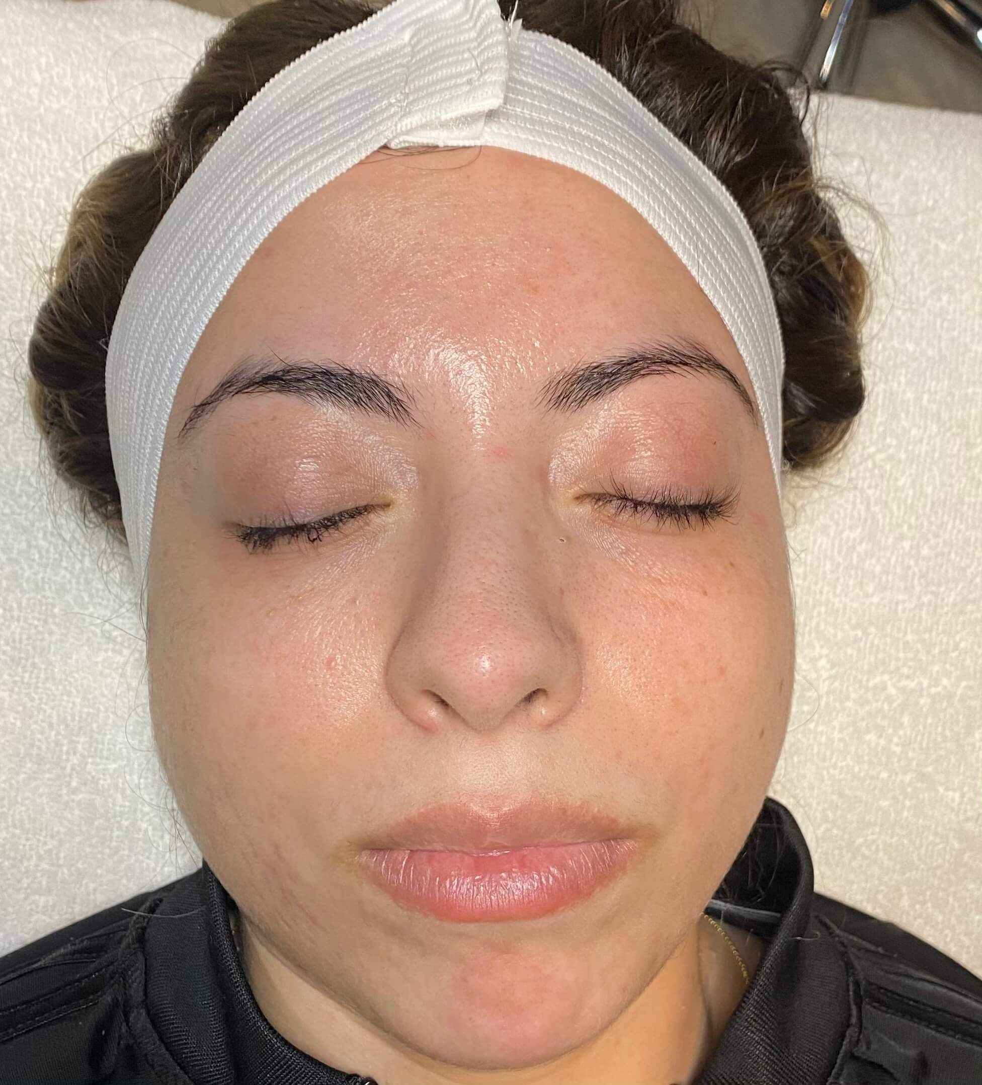 Chemical Peel Series After