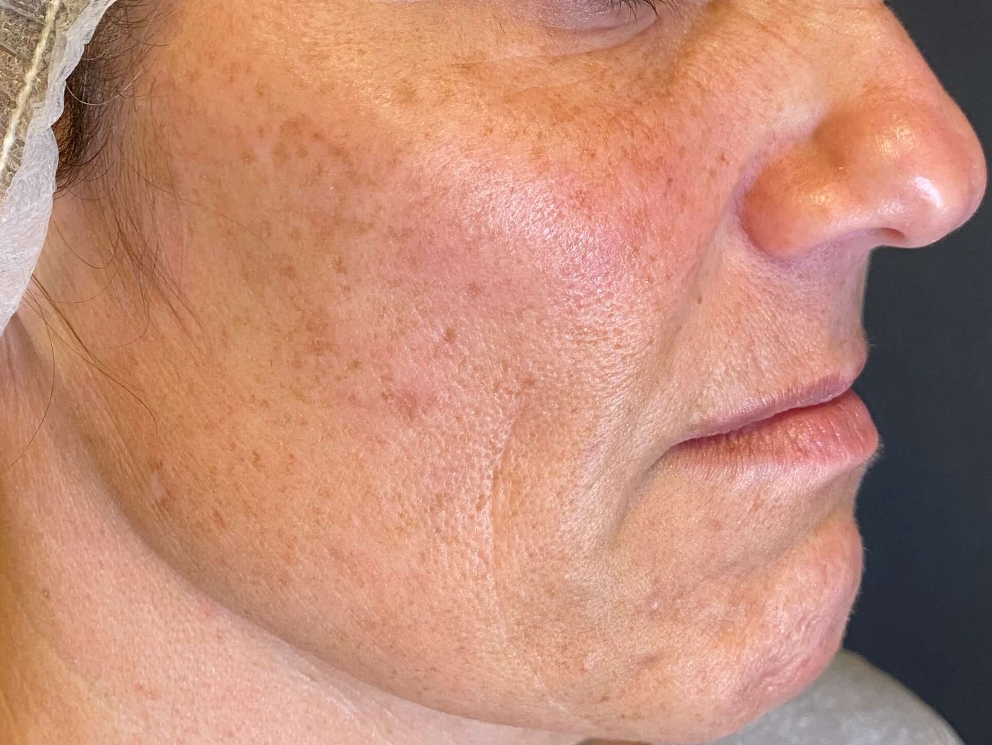 BBL Laser sun damage Before