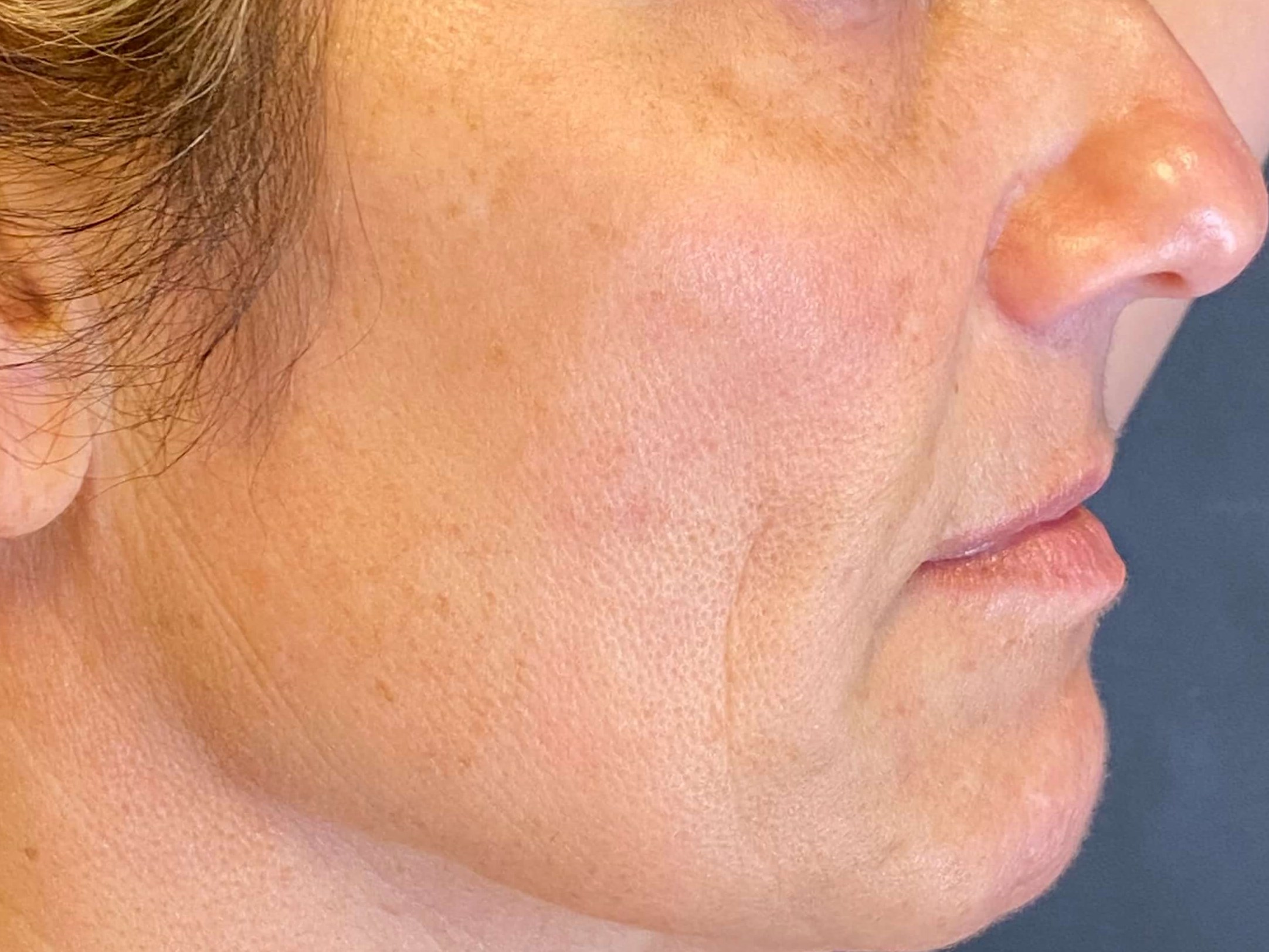 BBL Laser sun damage After