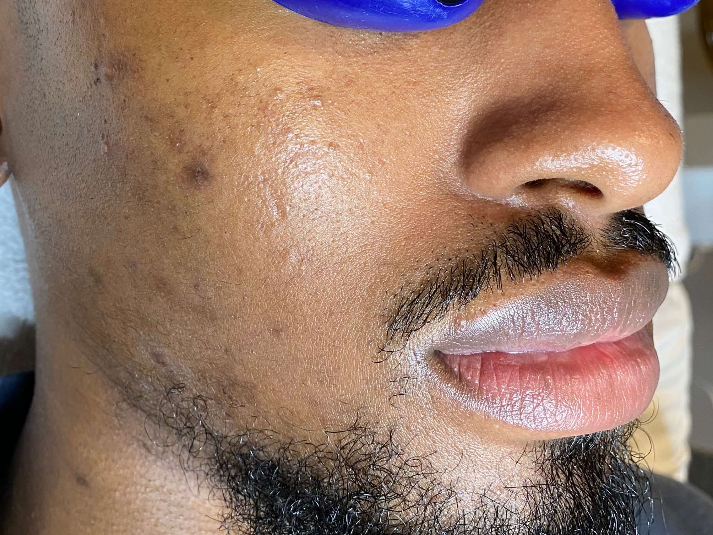 Melanage Peel Before