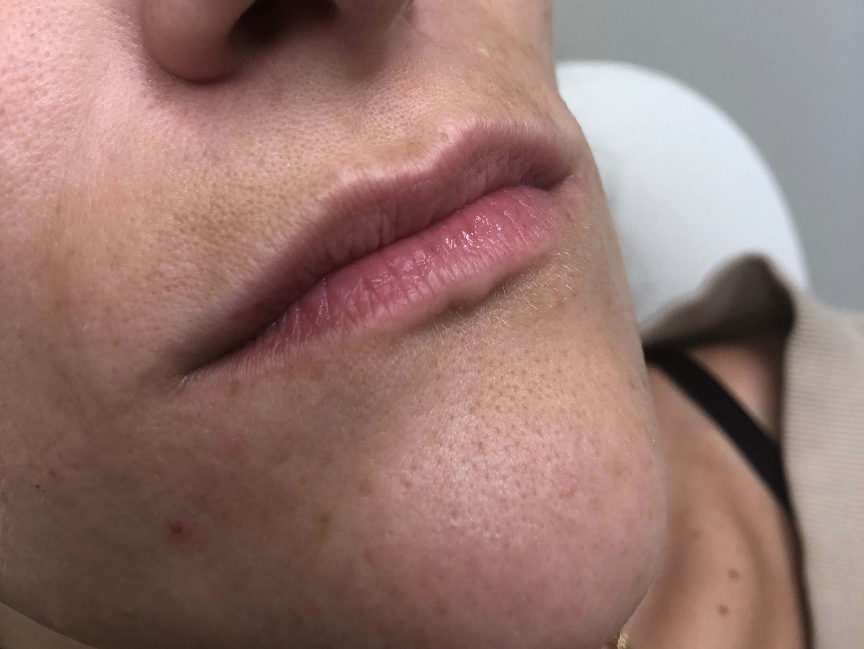 Juvederm lip fillers Before