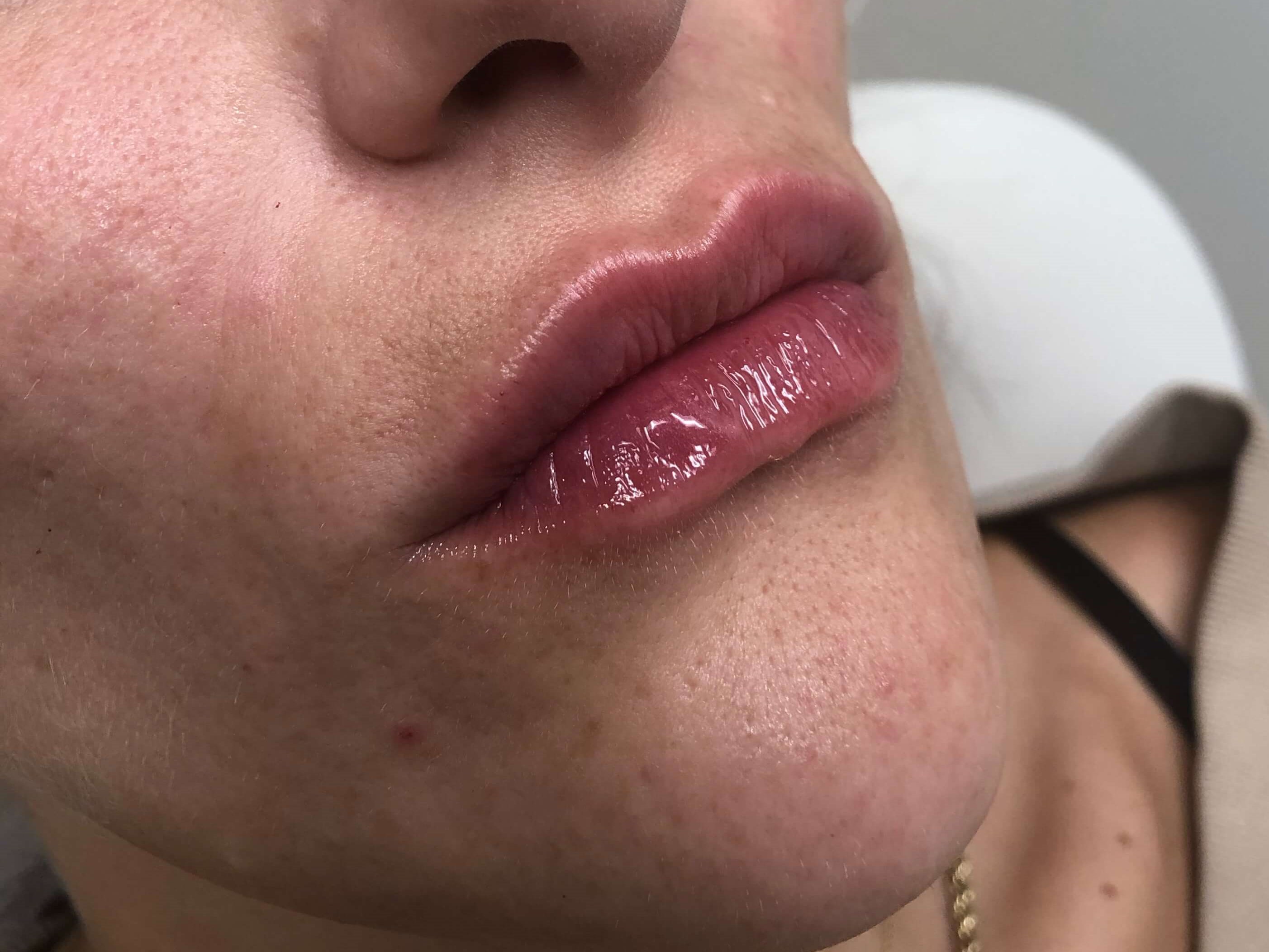 Juvederm lip fillers After