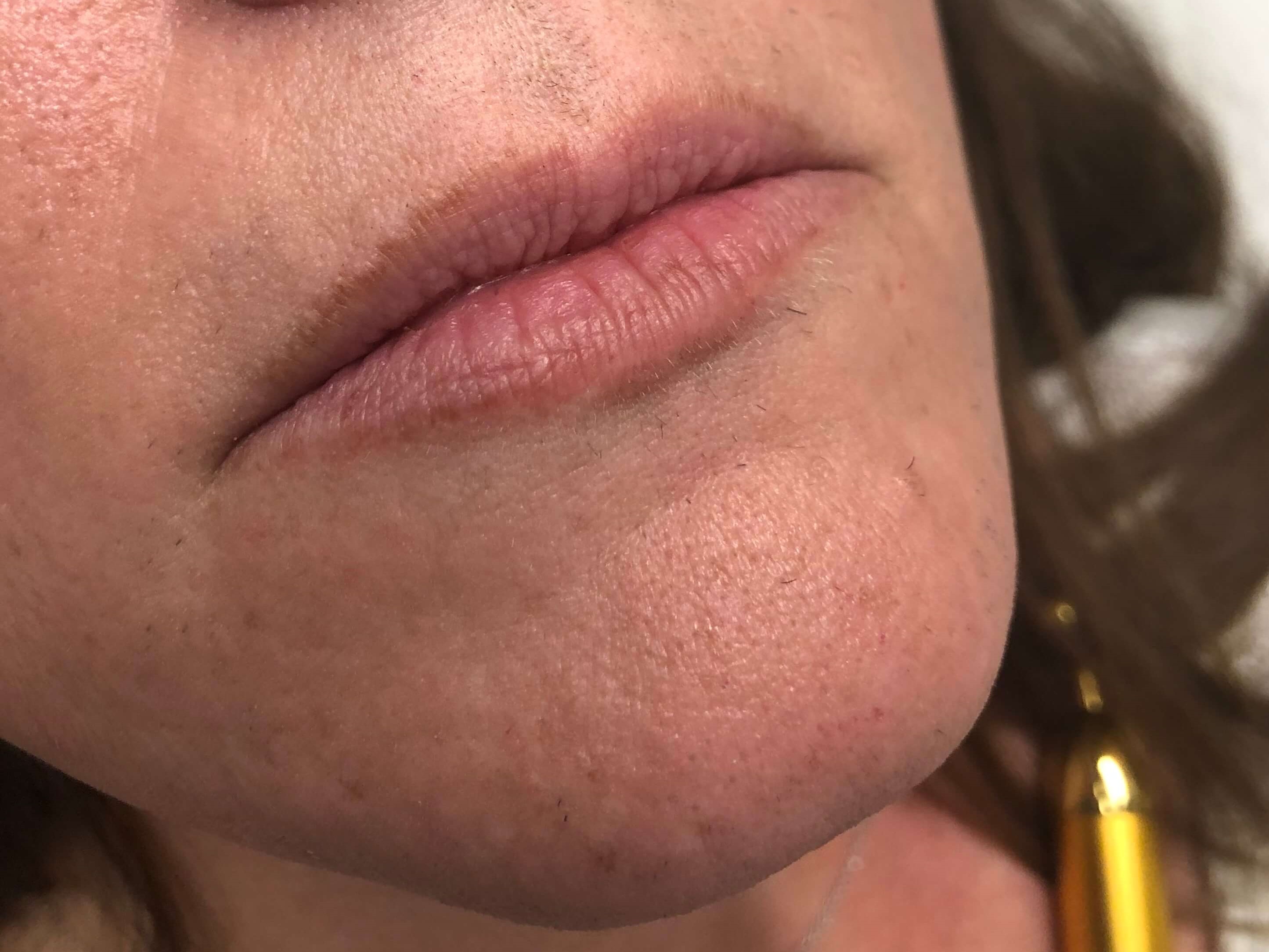 Juvederm Lip Enhancement Before