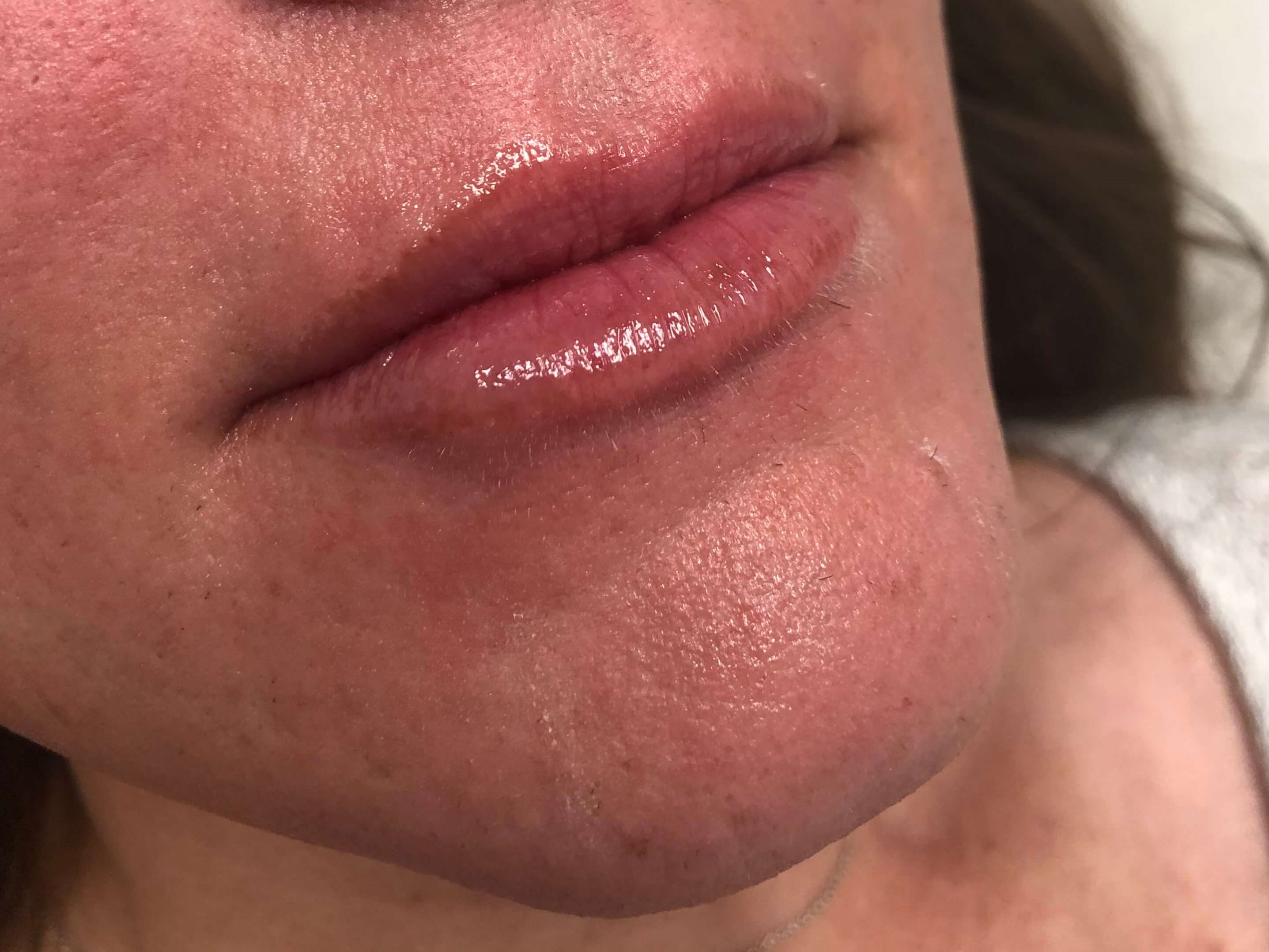 Juvederm Lip Enhancement After