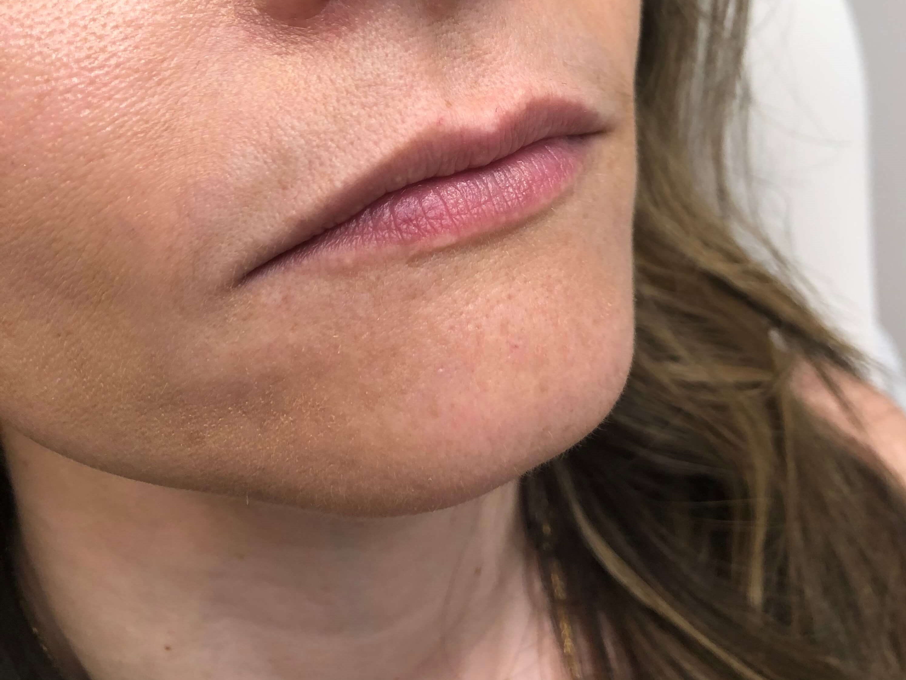 Juvederm Lip Enhancement Before