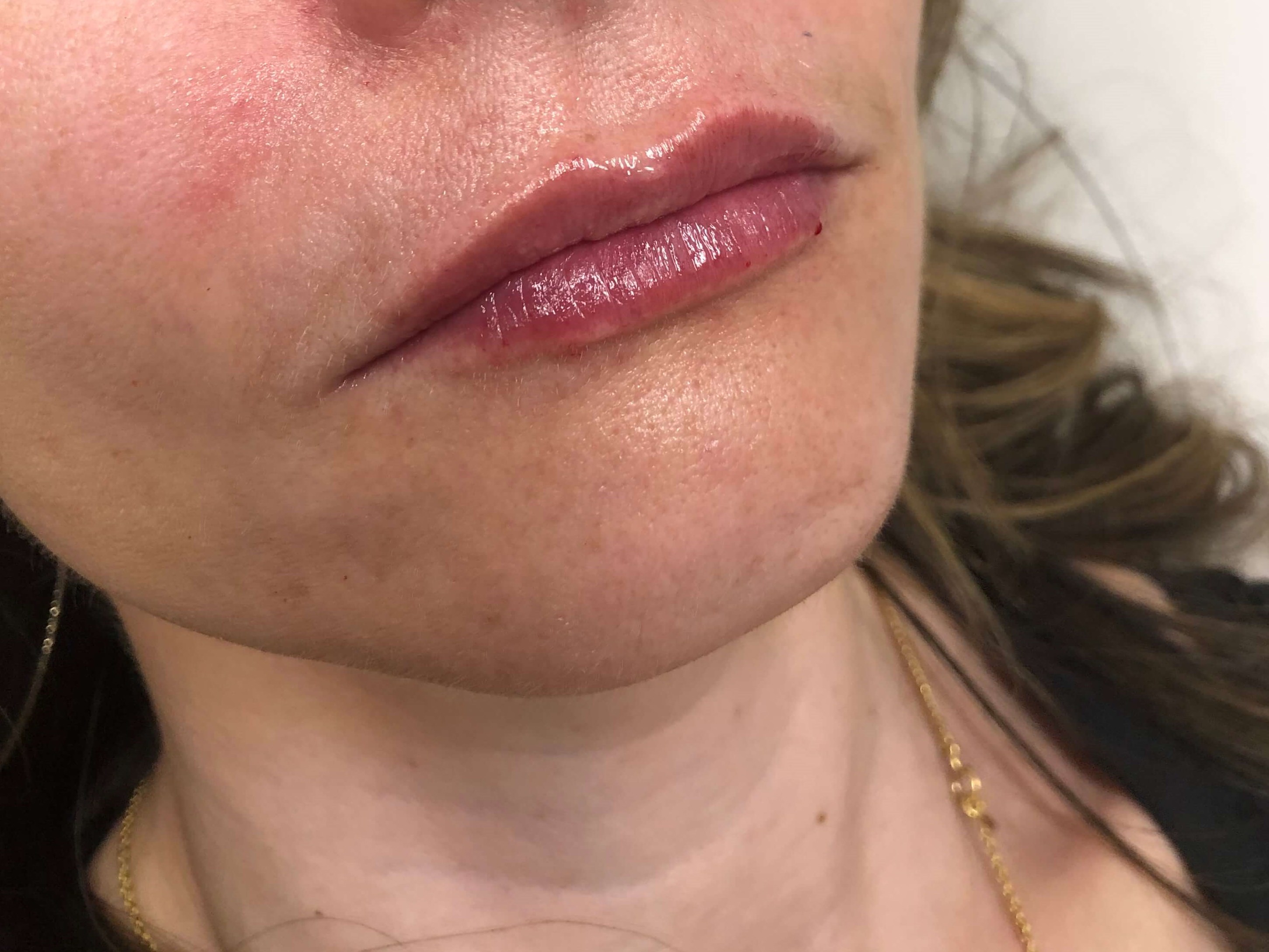 Juvederm Lip Enhancement After