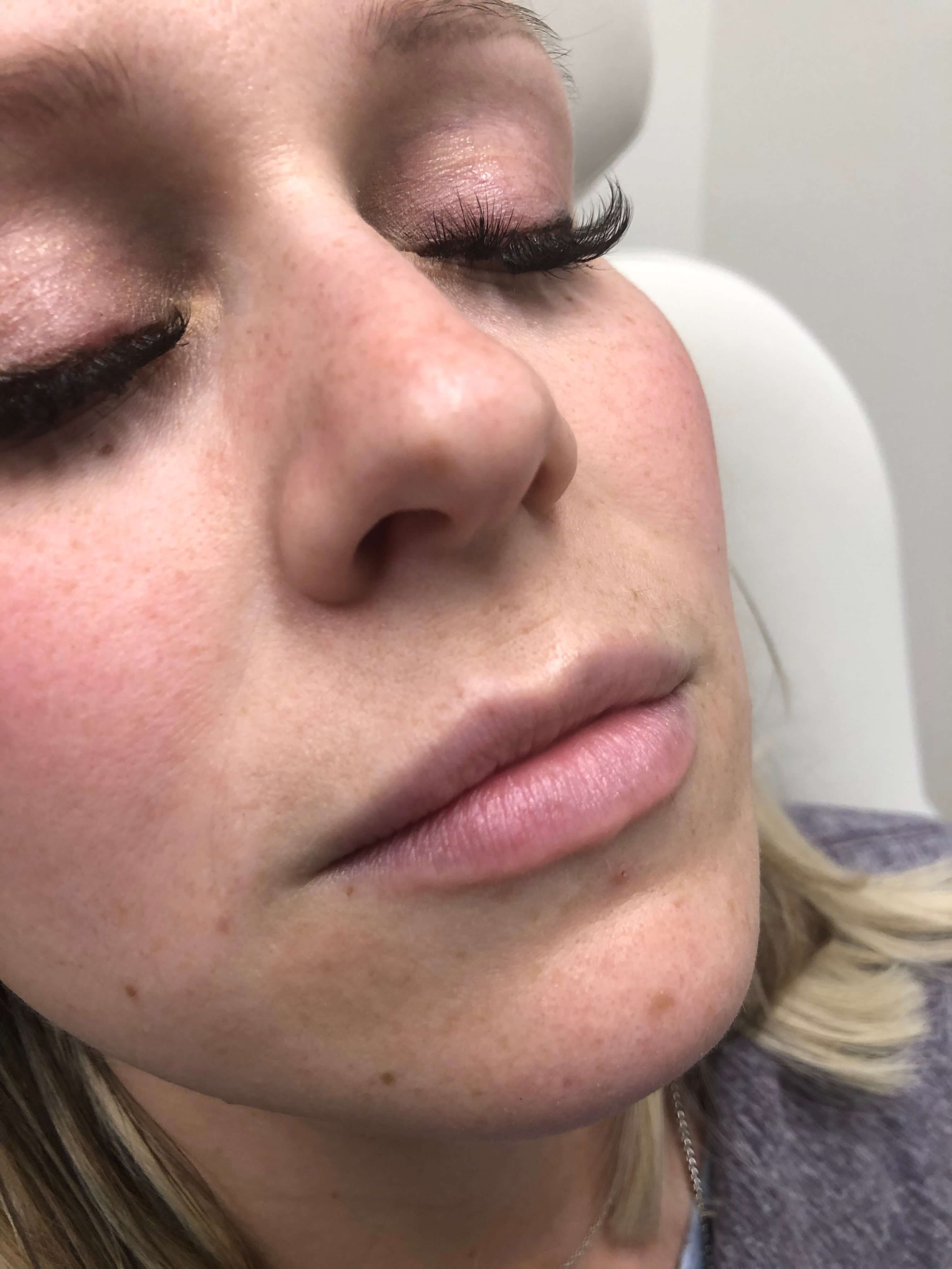 Juvederm Lip Enhancement Before
