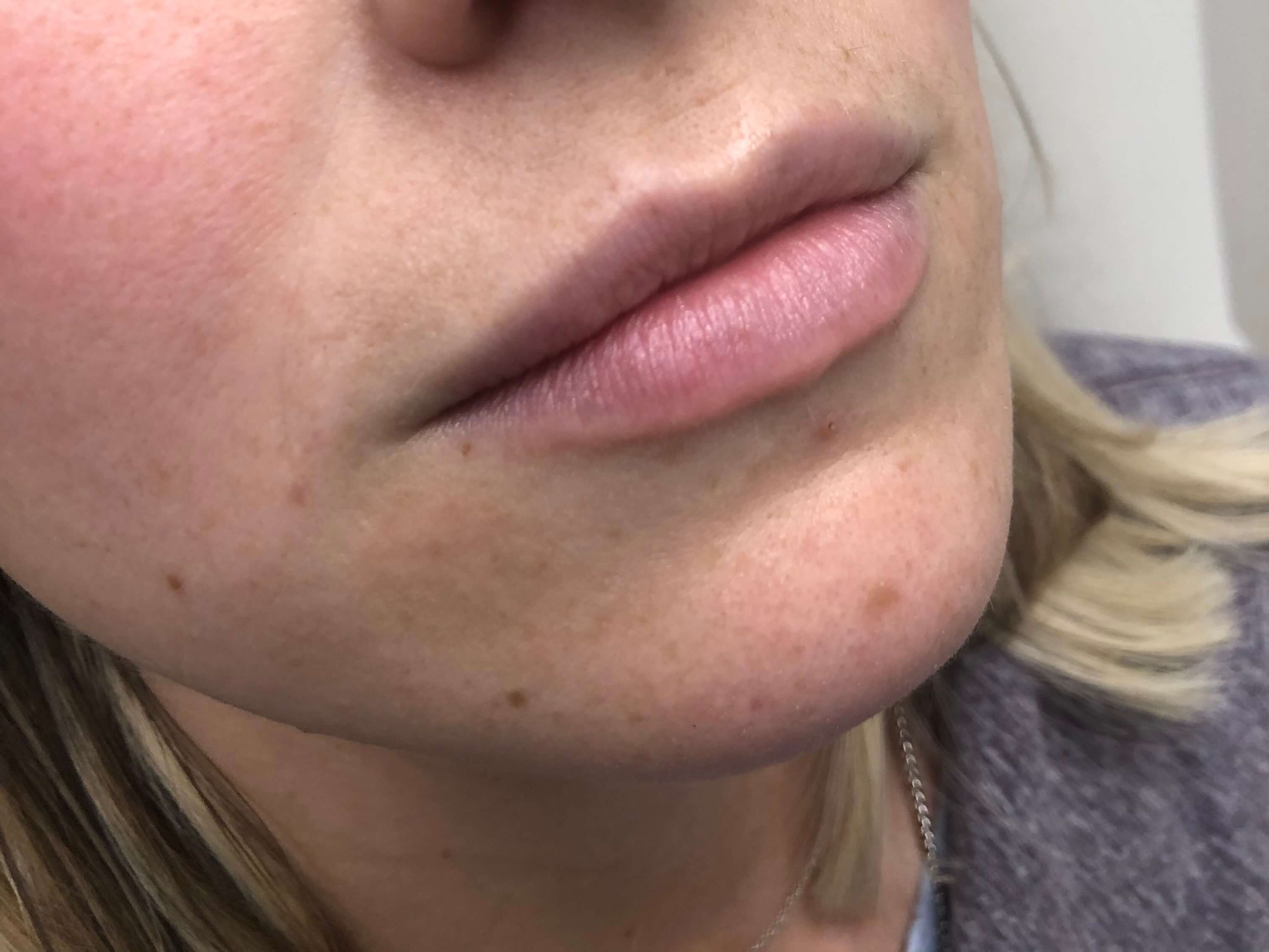 Juvederm Lip Enhancement Before