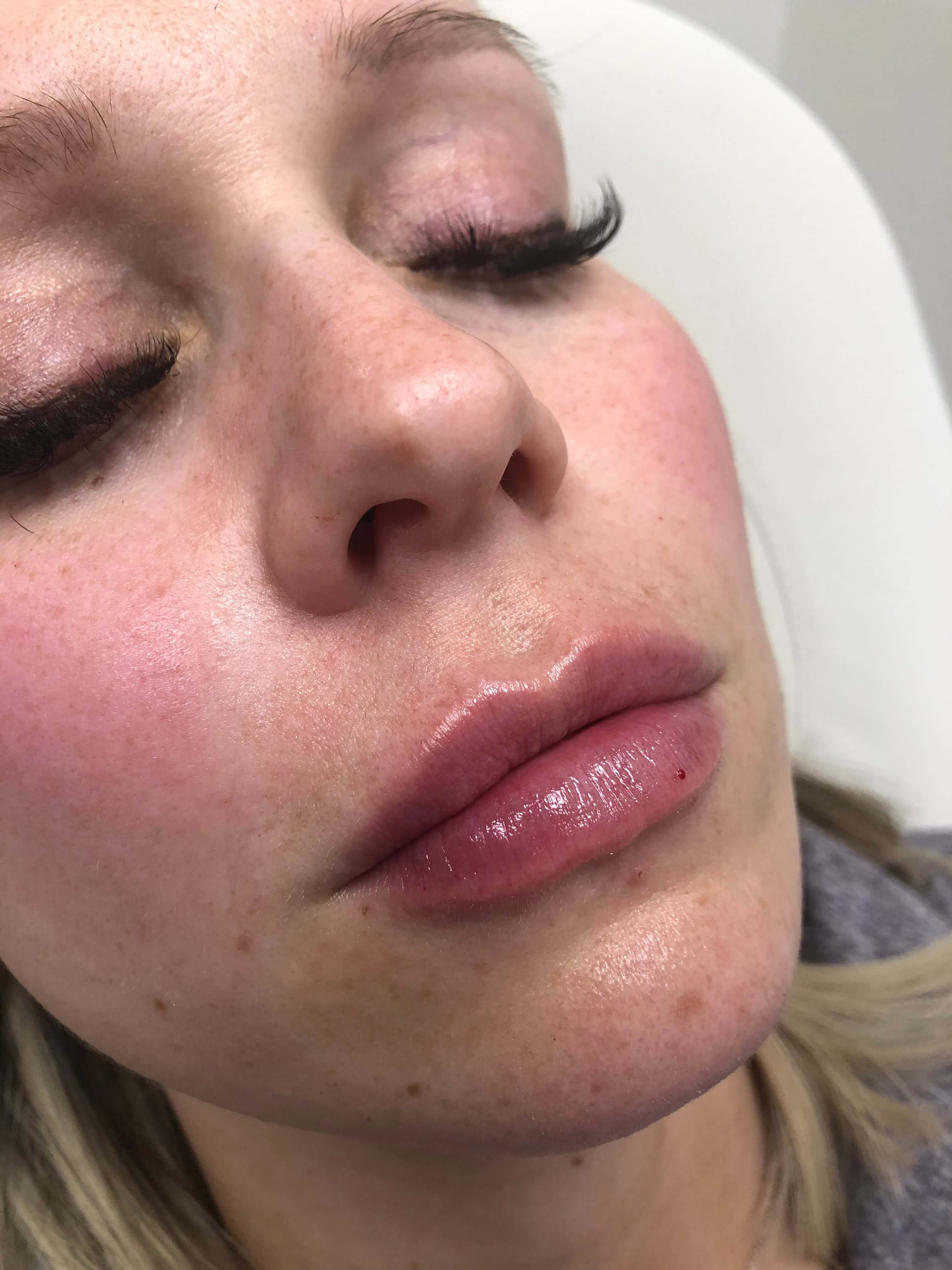 Juvederm Lip Enhancement After