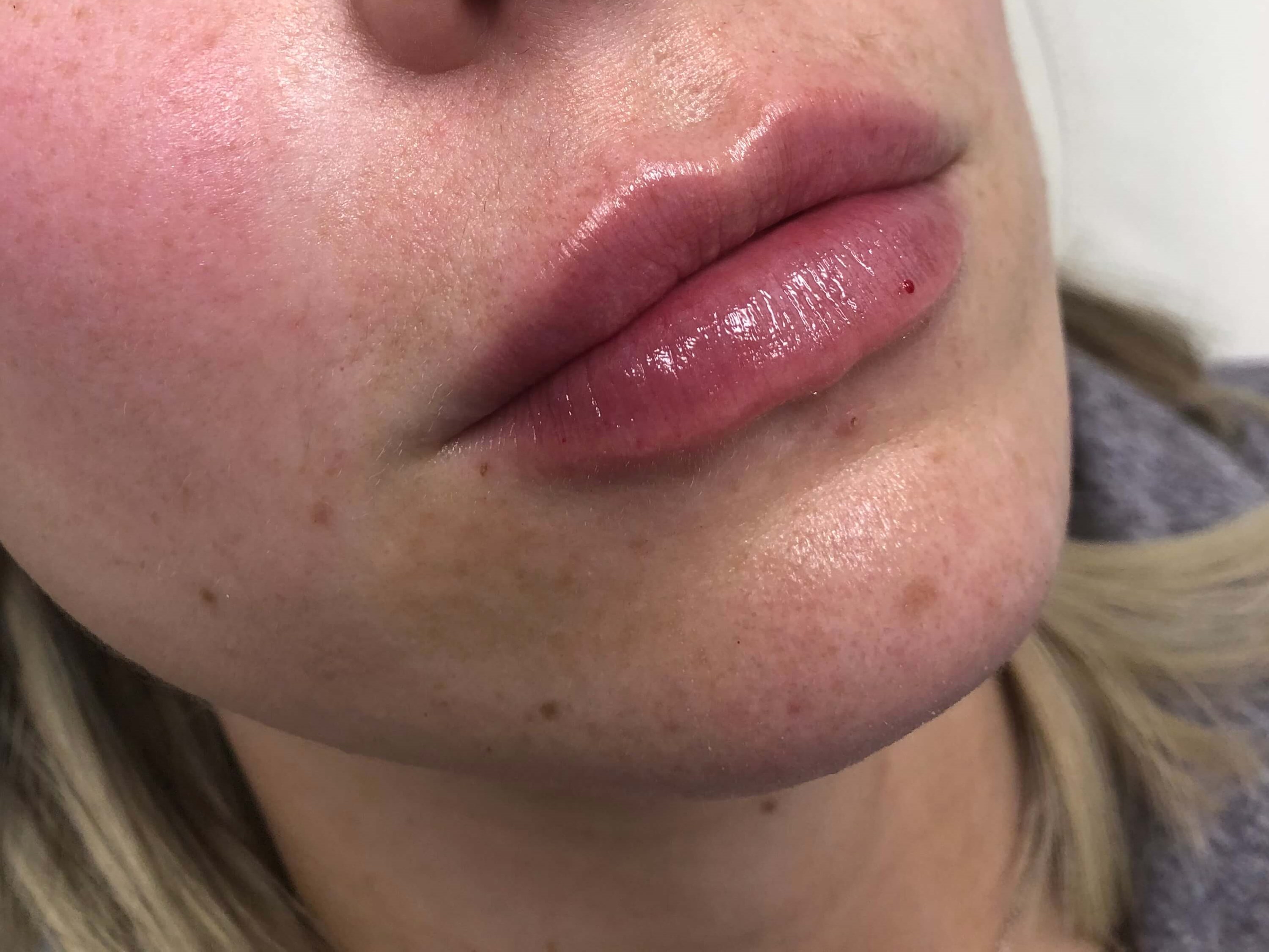 Juvederm Lip Enhancement After