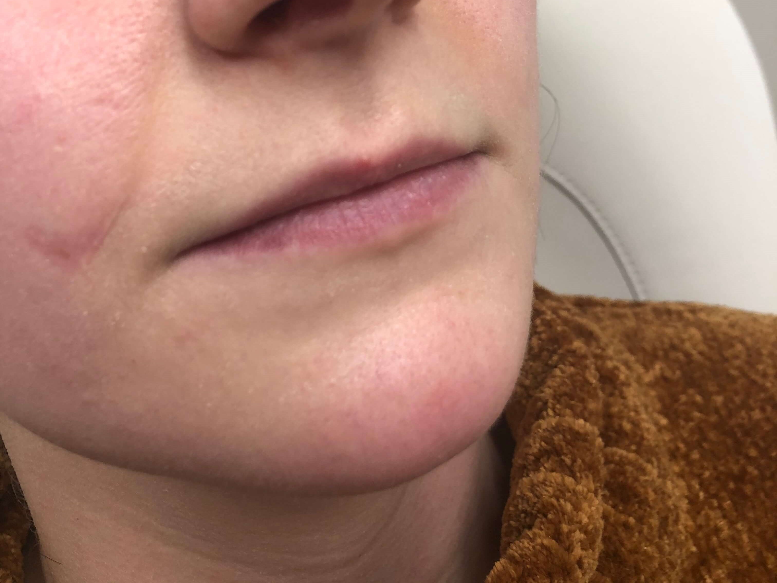 Juvederm Lip Enhancement Before