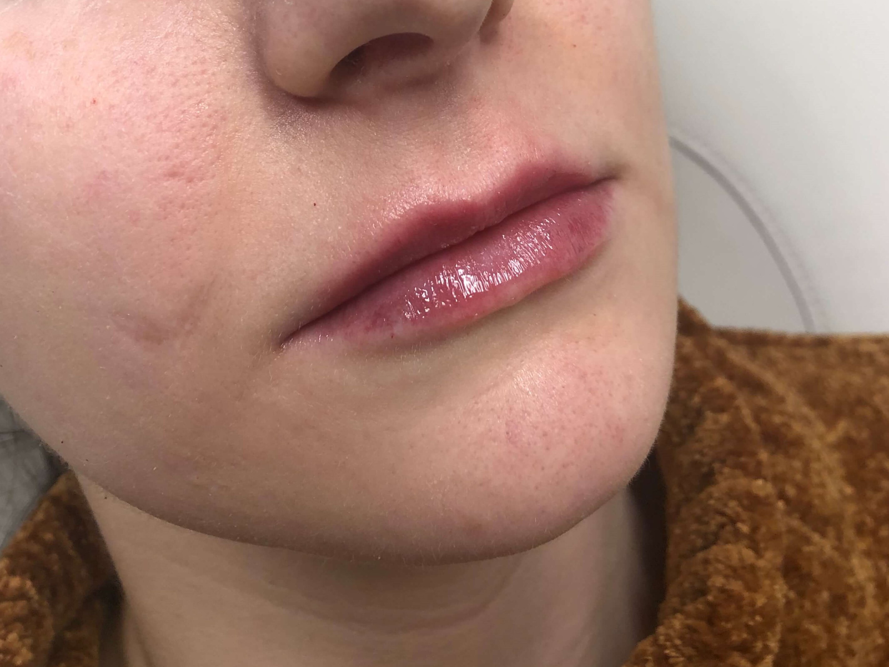 Juvederm Lip Enhancement After