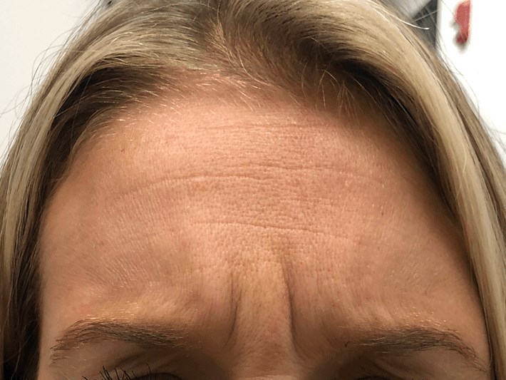 Botox Forehead wrinkles Before