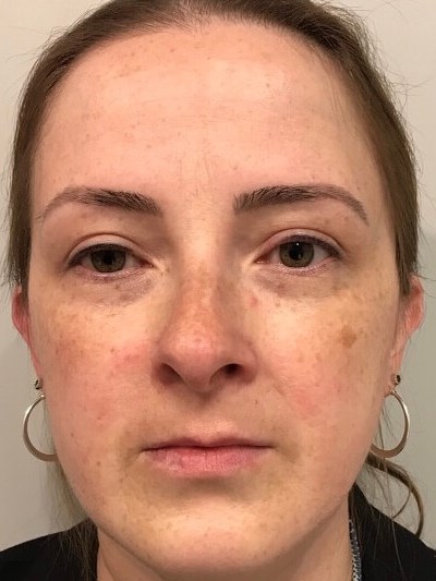 BBL Laser Sun Damage Before