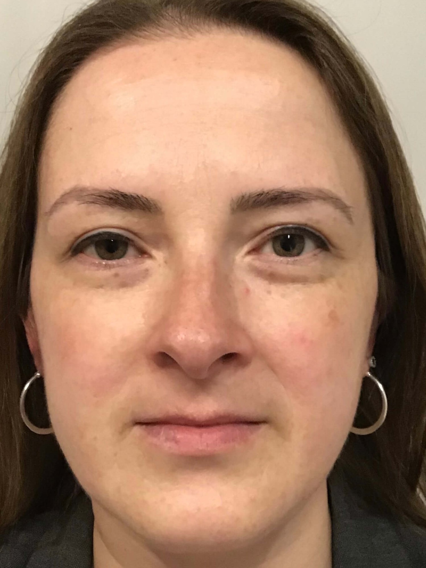 BBL Laser Sun Damage After