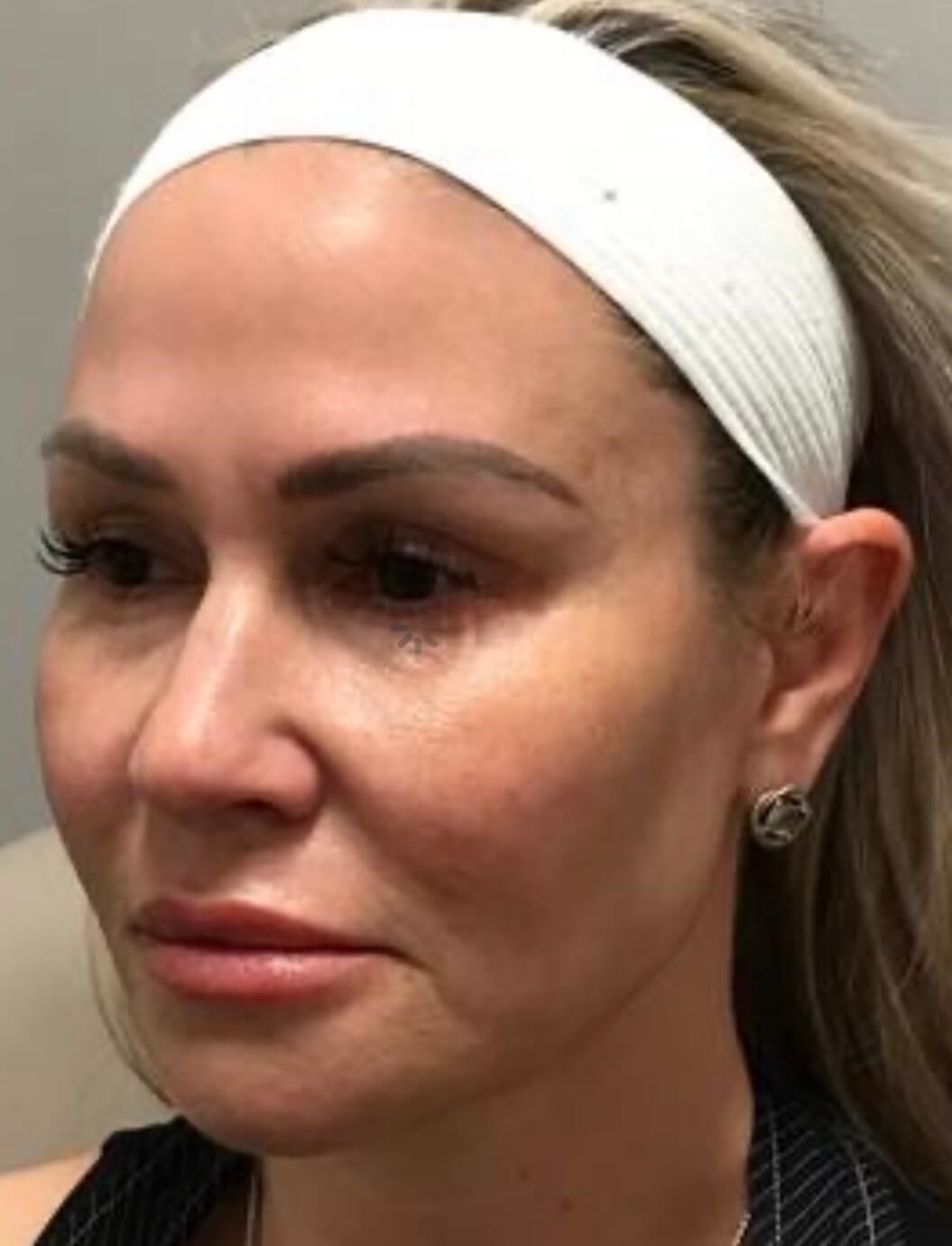 Nonsurgical Facial fillers Before
