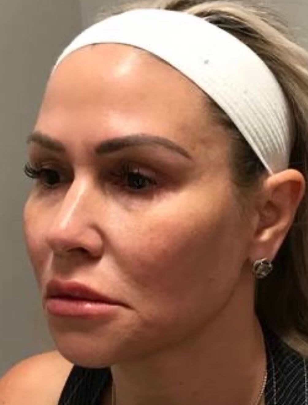 Nonsurgical Facial fillers After