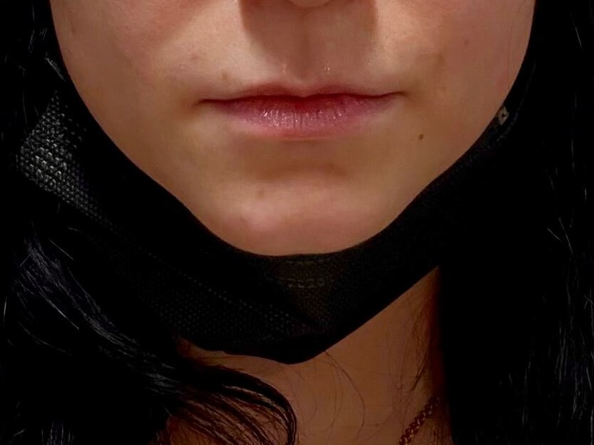 Juvederm Lip Enhancement Before