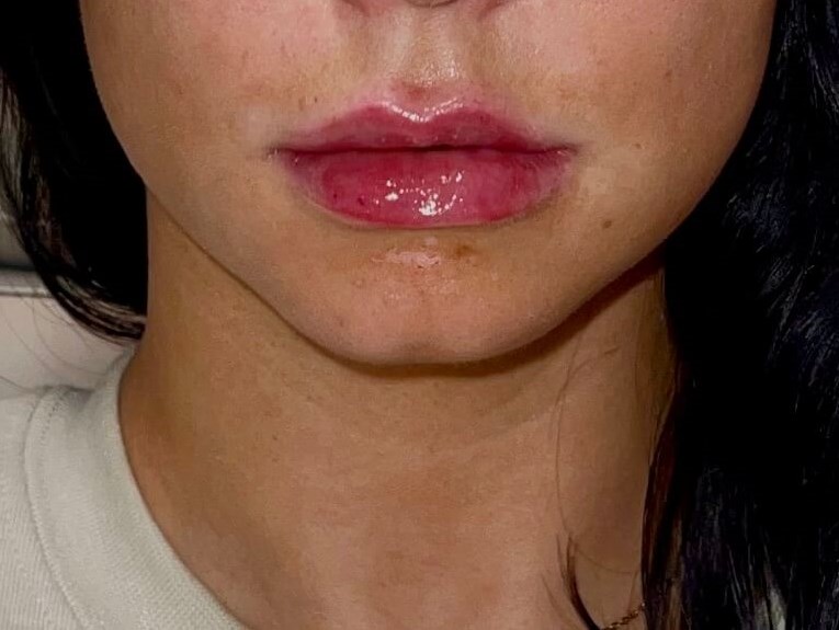 Juvederm Lip Enhancement After