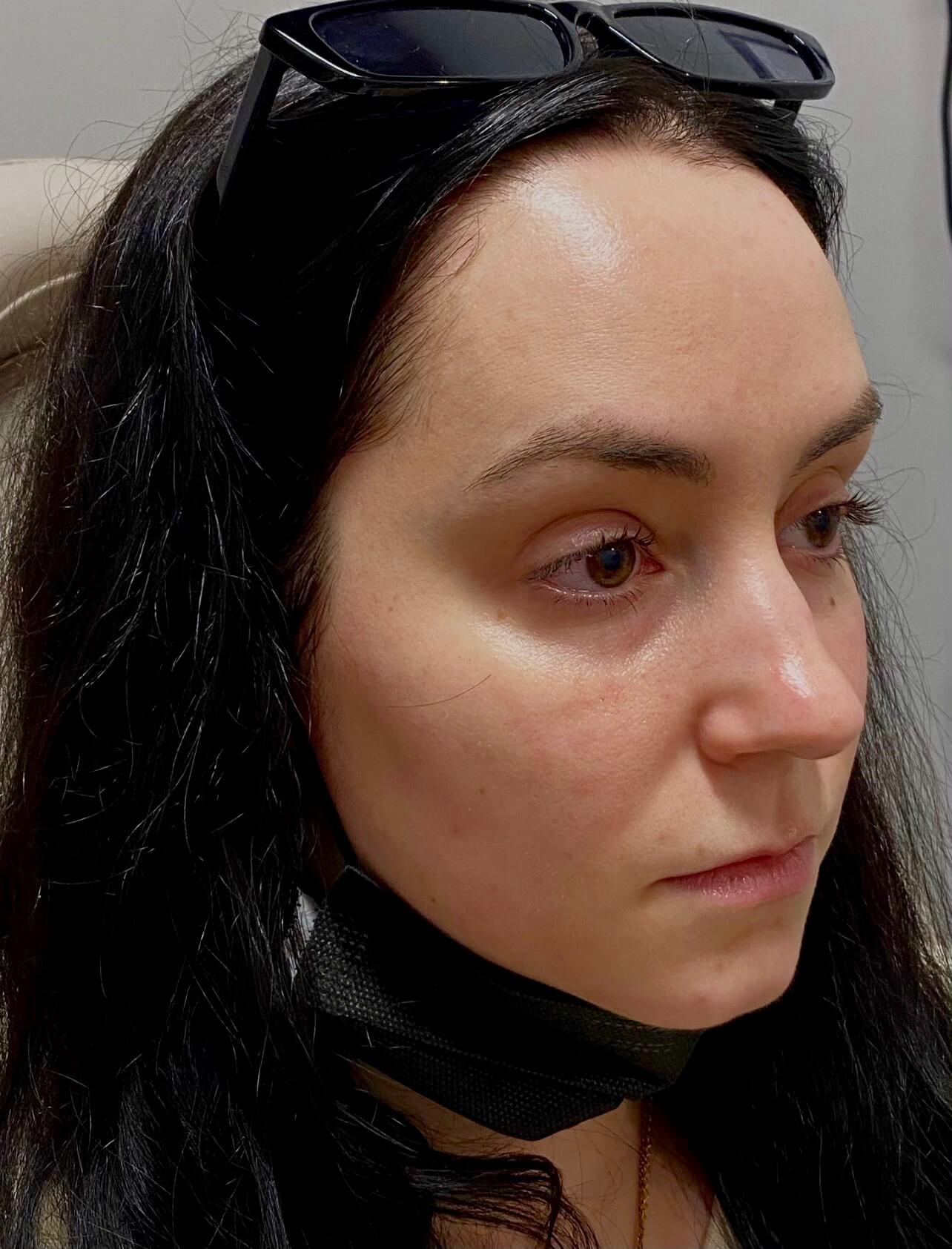 Juvederm Lip Enhancement Before