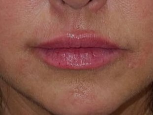 Juvederm Lip Enhancement After