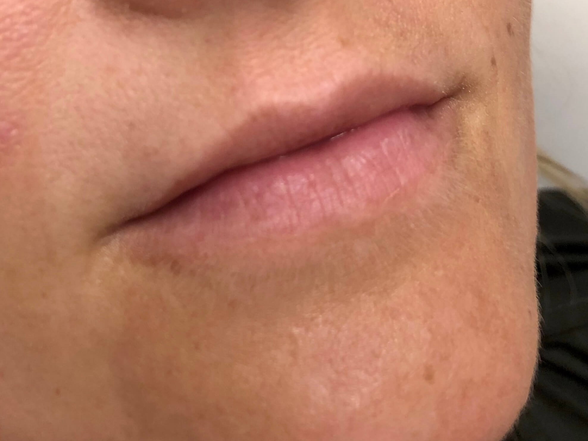 Juvederm Lip Enhancement Before