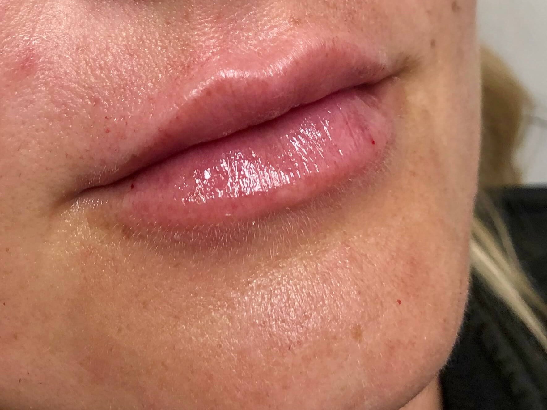 Juvederm Lip Enhancement After