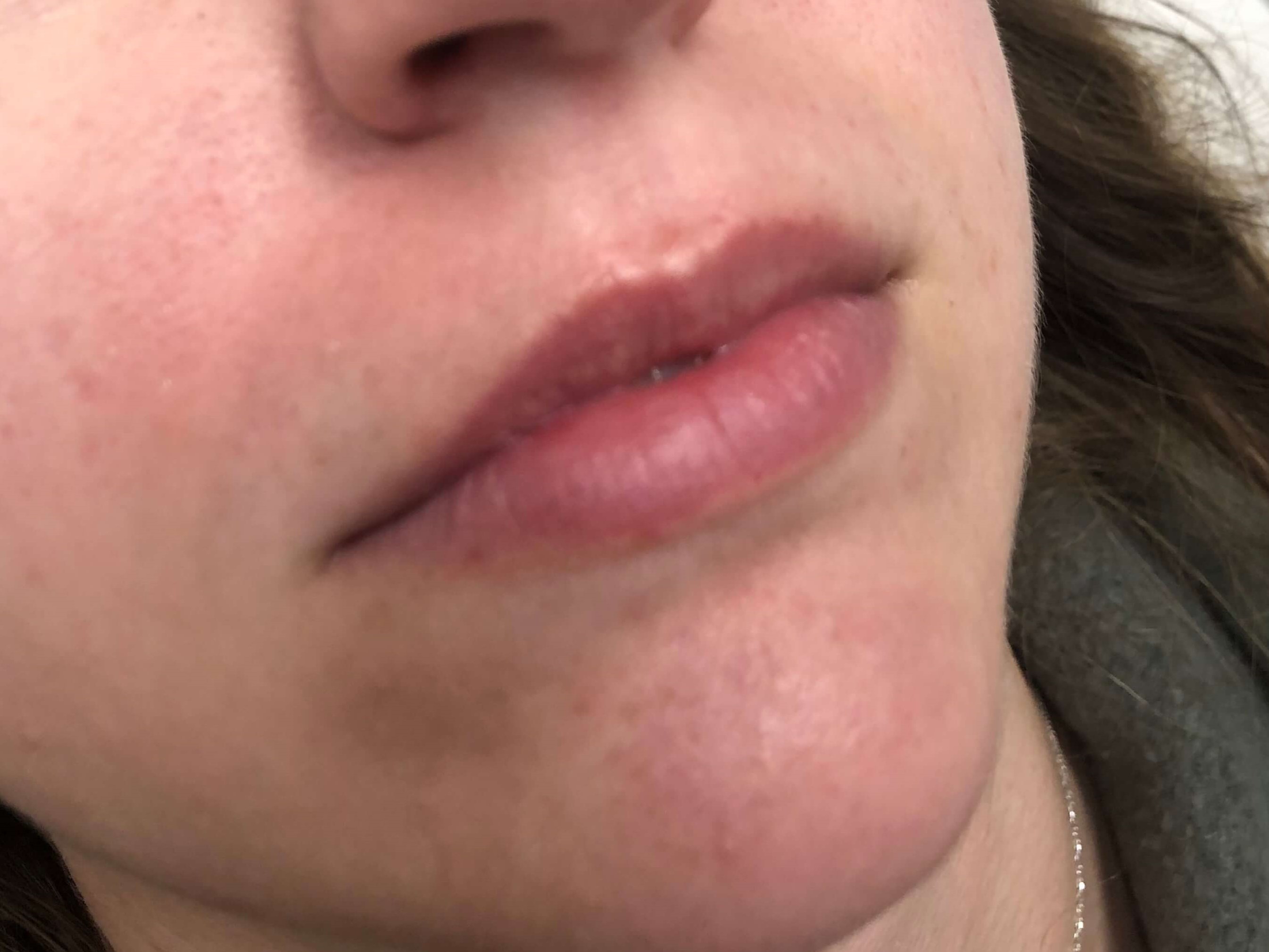Juvederm Lip Enhancement Before