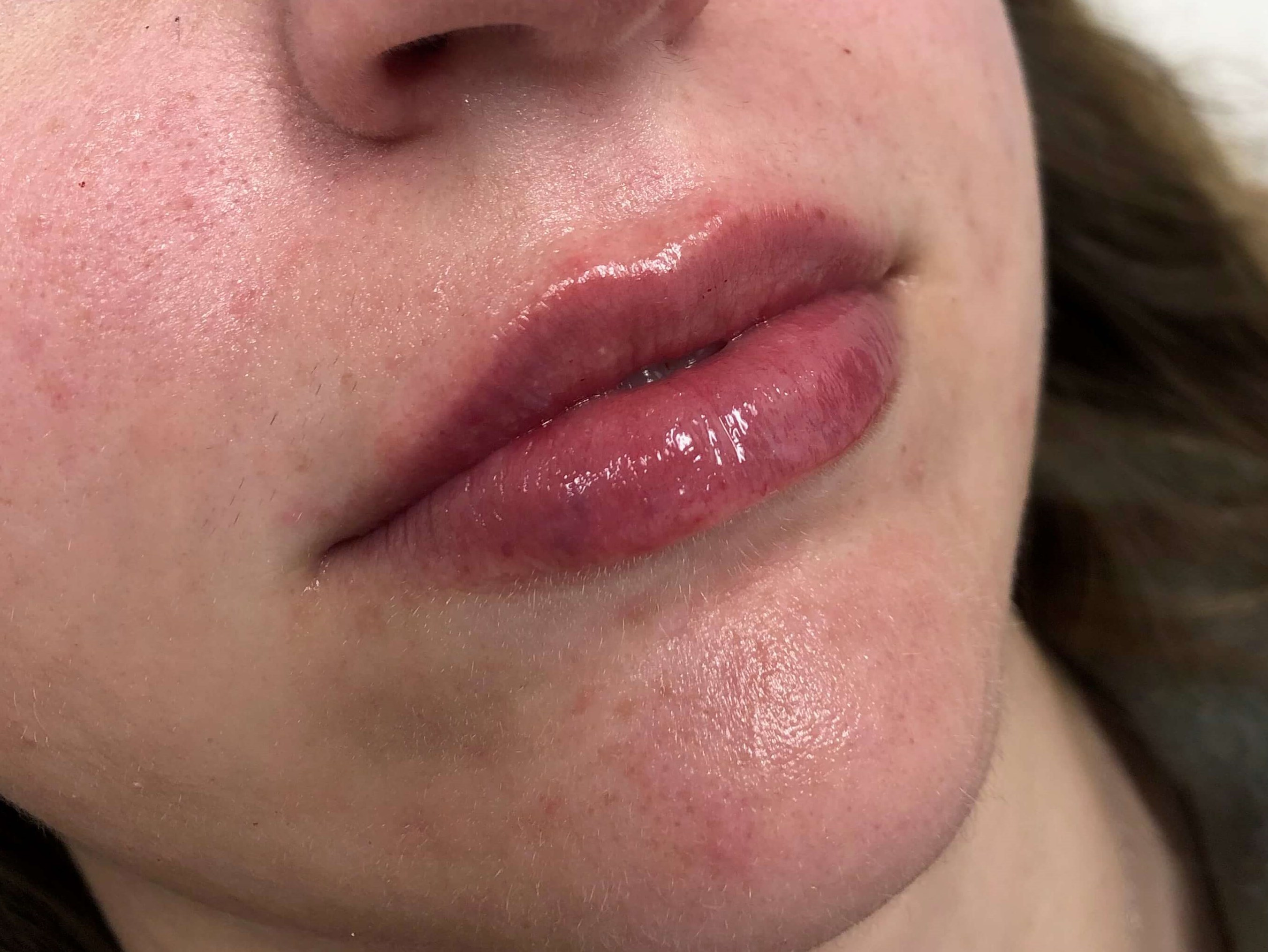 Juvederm Lip Enhancement After