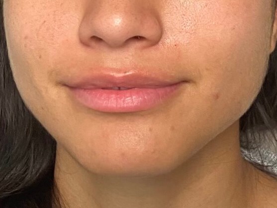 Juvederm lip Enhancement Before