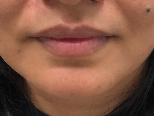 Juvederm Lip Enhancement Before
