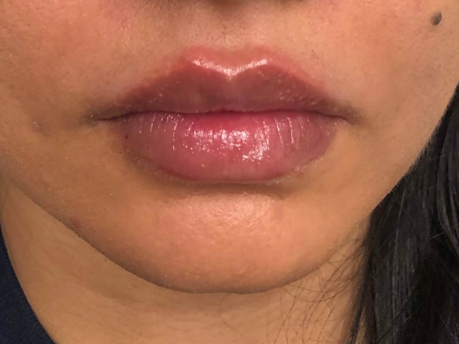Juvederm Lip Enhancement After