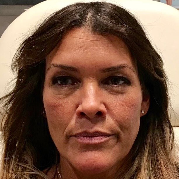Juvederm Facial Rejuvenation Before